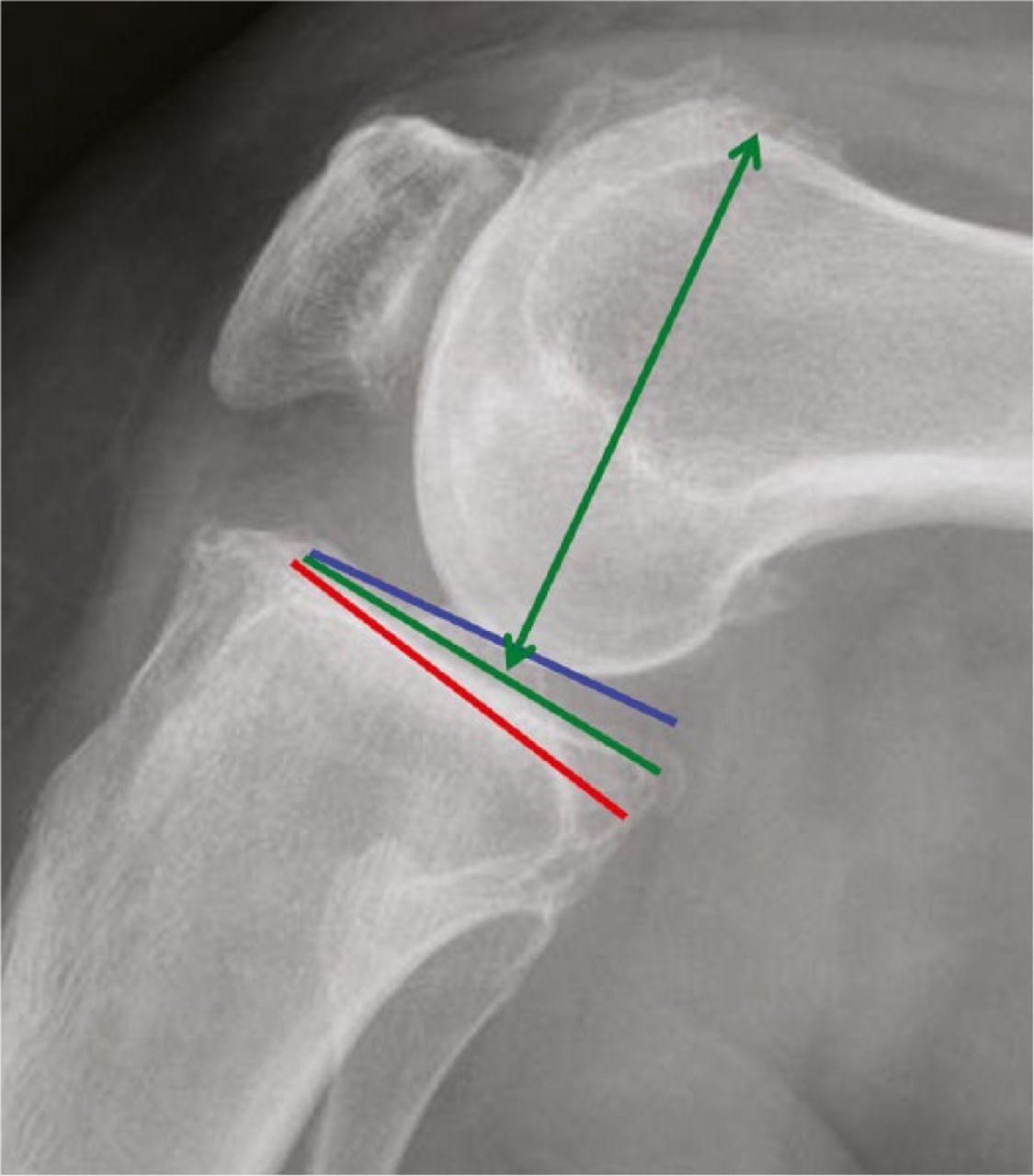 Fig. 11 
            The flexion gap: the spatial relationship between femur and tibia in flexion is a product of the femoral AP size (including posterior femoral offset) and a matching tibial plateau height and posterior slope (green). If the tibial plateau is made more steep (red line) laxity results, less steep (blue line) results in tension.
          