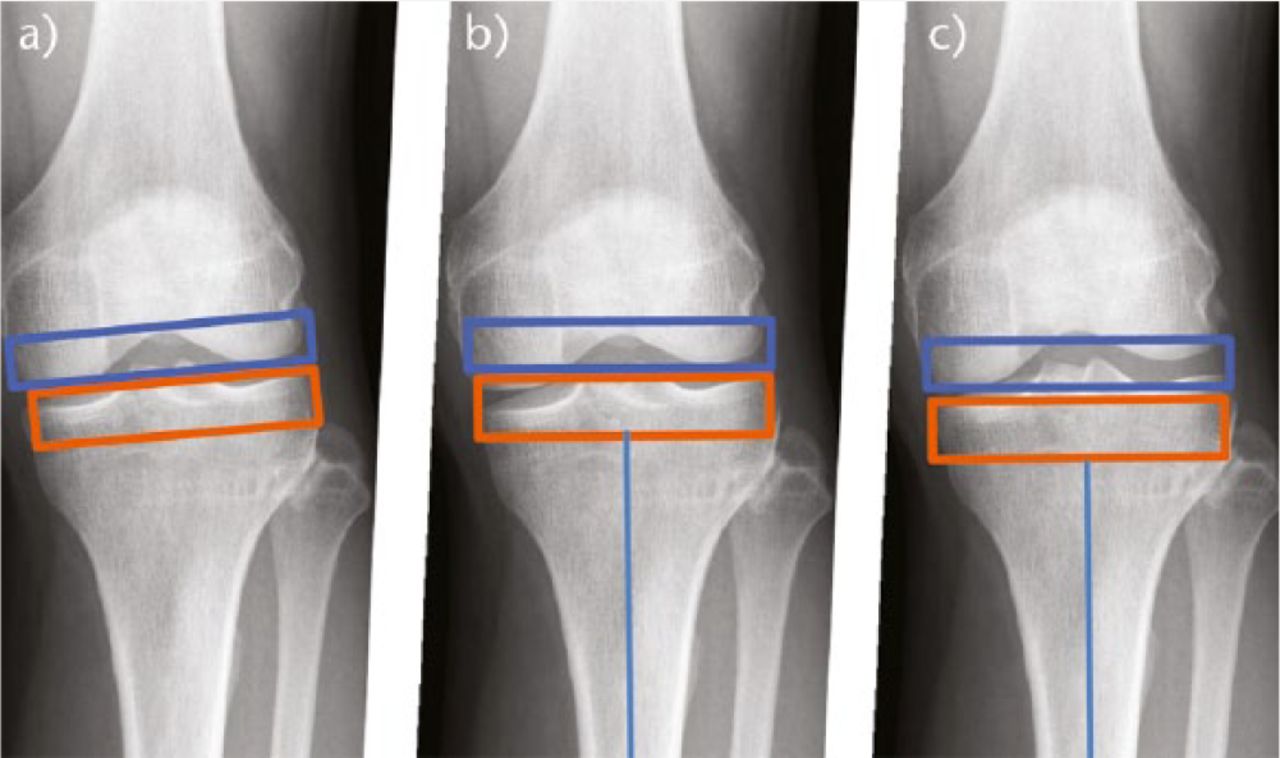 Fig. 13 
          The surgeon has three means of joint line restoration. a) ‘kinematic’ – sloping resections passing through both joint lines; b) perpendicular resections centred on the lateral joint line (the medial femoral condyle is downsized to match the lateral); c) conventional TKA resections centred on the medial joint line (the lateral femoral condyle is upsized to match the medial femoral condyle).
        