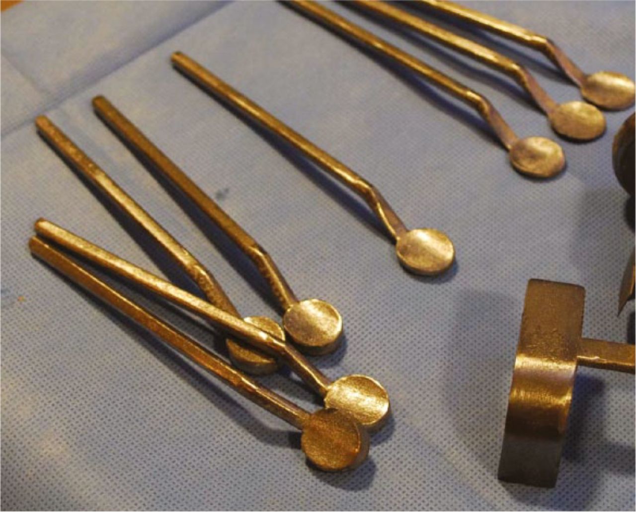 Fig. 14 
          ADVANTicS technique joint gap guides in a selection of thicknesses are introduced into the joint space vacated by eroded articular cartilage. The surgeon can ‘fine tune’ the tension in each compartment and identify the joint line from which resections are measured.
        