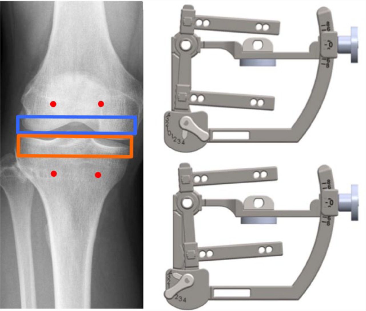 Fig. 15 
          The default function produces a rectangular extension gap perpendicular to the tibial axis, of the correct size and centred on the lateral joint line (left). Kinematics can be optionally introduced in a controlled fashion to allow a compromise to be reached if there is a large discrepancy between the medial and lateral joint line heights (right).
        