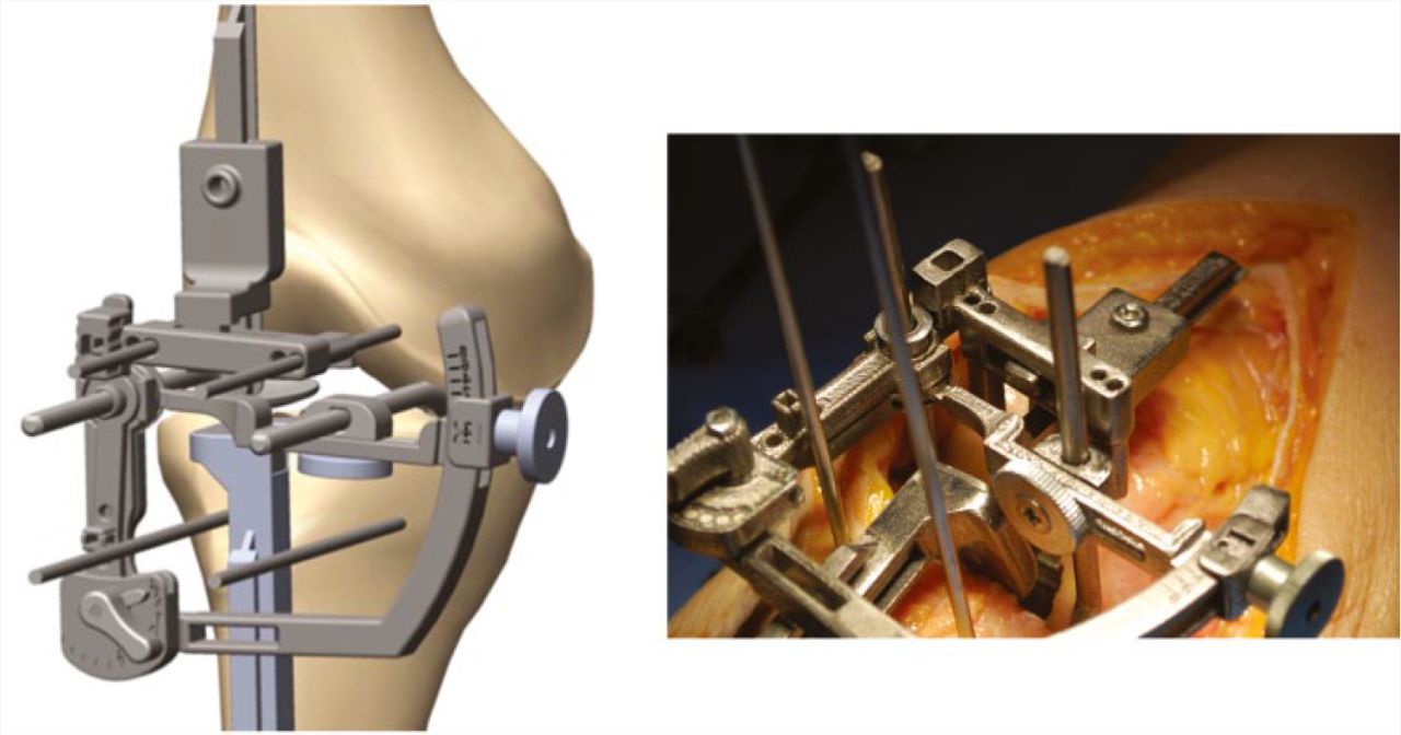 Fig. 16 
          ADVANTicS system joint level finder connects onto joint gap guides and pins for tibial and femoral resections, simultaneously (cadaver).
        