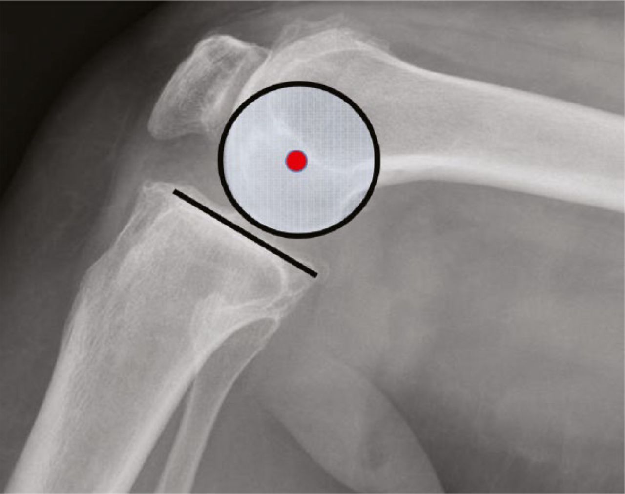 Fig. 2 
          Femoral-tibial articulation follows a circular path around the distal femoral rotation axis.
        