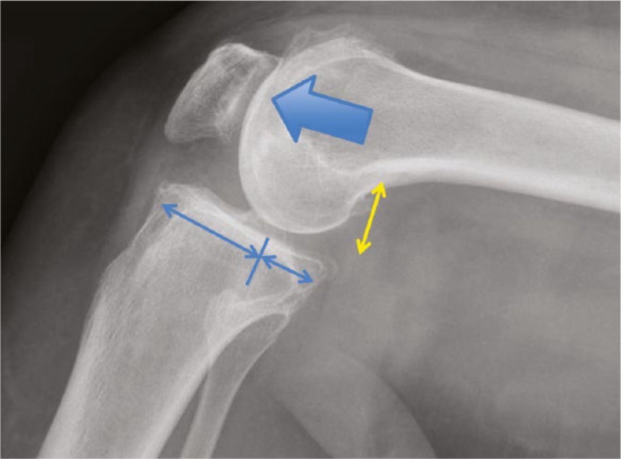 Fig. 5 
          In flexion, the patella articulates with the distal aspect of the lateral femoral condyle and trochlea. Distalisation of the lateral femoral condyle exerts pressure against the patella and soft tissue envelope. The femur articulates with the tibia at the 2/3 posterior position. The posterior femoral offset is shown by the yellow arrow.
        