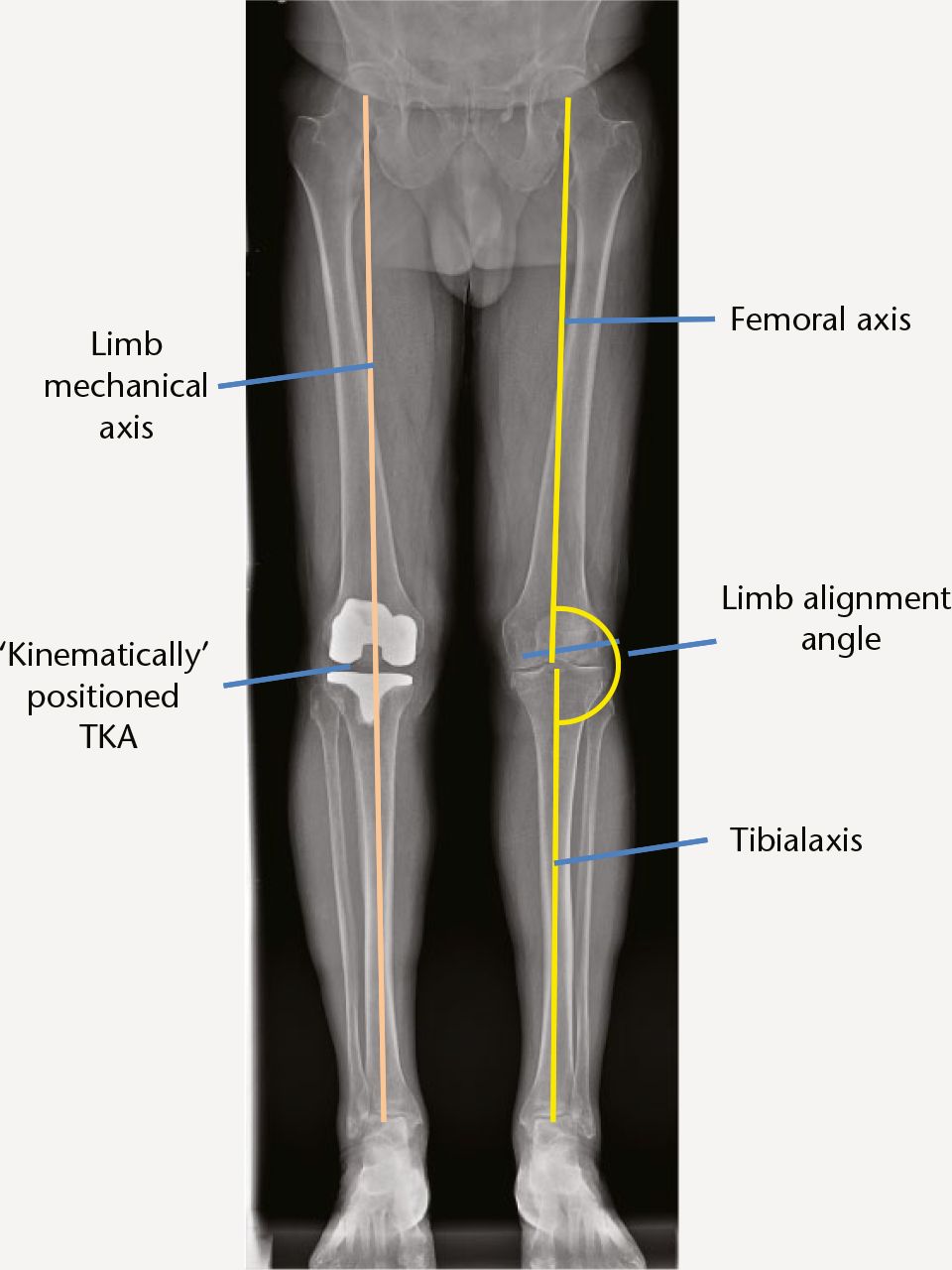 Fig. 6 
            The axes of the lower limb and a ‘kinematically’ positioned TKA, corresponding to the differing heights of the medial and lateral compartments but not perpendicular to the limb mechanical axis.
          