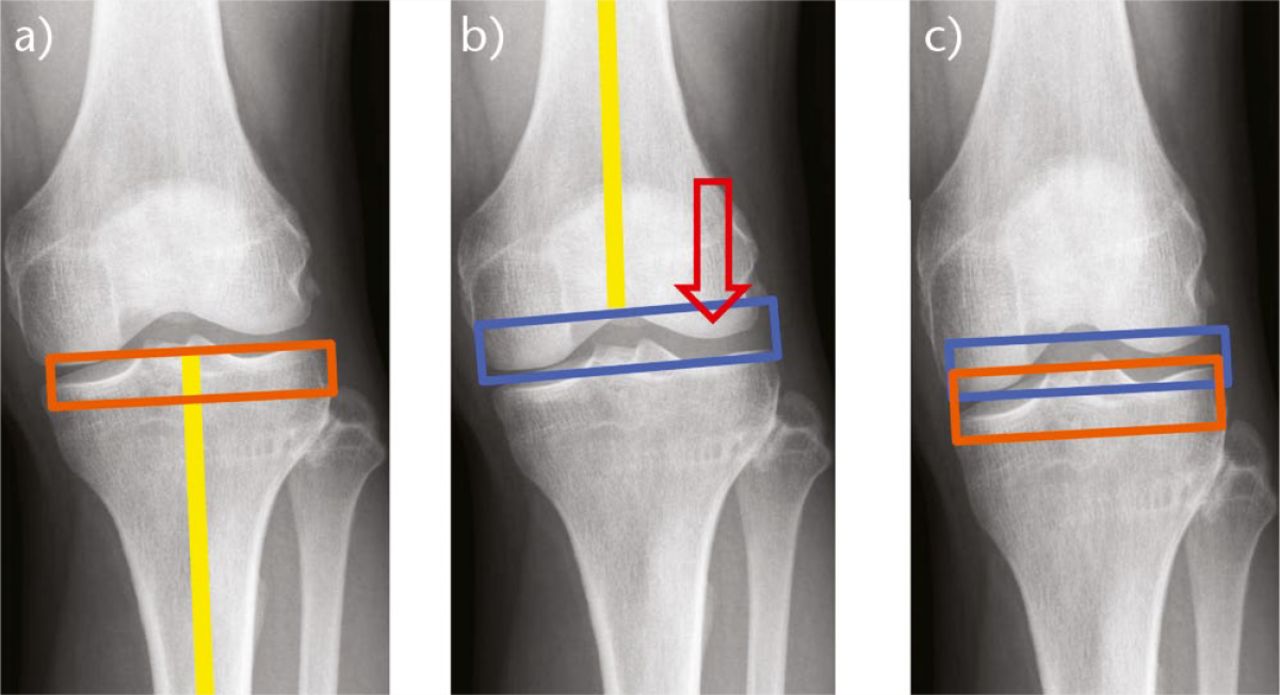 Fig. 7 
            a) Conventional technique resects less than implant thickness from the medial tibial plateau, raising the medial joint line with the implant; b) the distal femoral resection is measured using jigs that rest against the more prominent medial femoral condyle; c) overlapping resections.
          