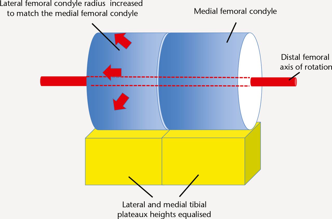 Fig. 8 
            Schematic representation of conventional TKA technique – The radius of the lateral femoral condyle is increased to match the medial femoral condyle. This can impart more tension on the patella and the soft tissue envelope.
          