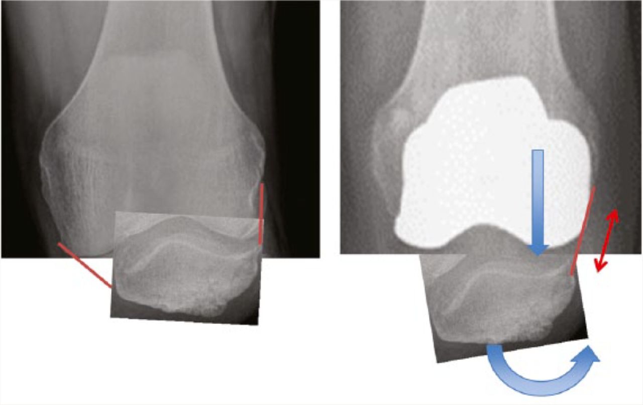 Fig. 9 
            Distalisation of the implant lateral femoral condyle exerts pressure against the patella.
          