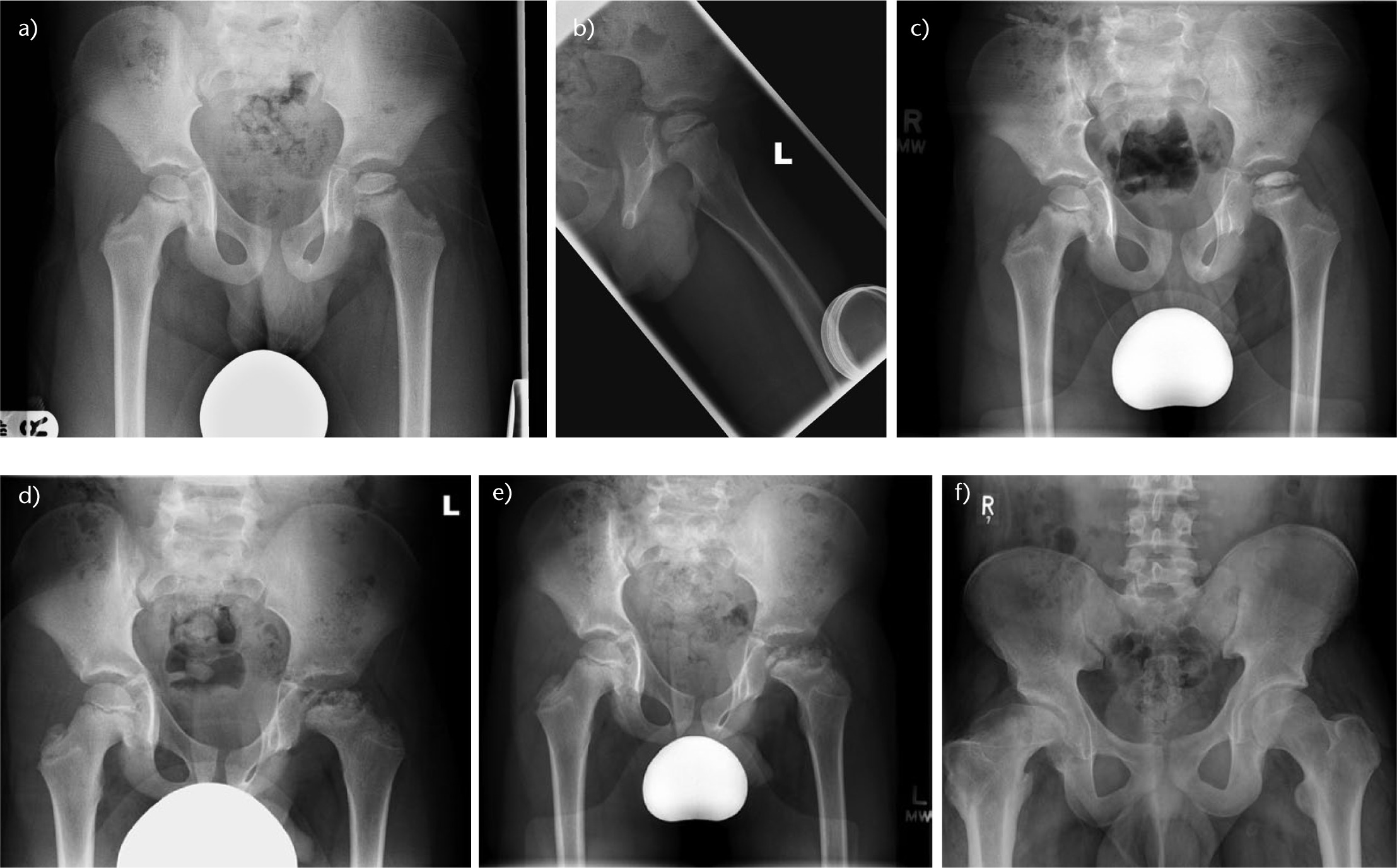 Fig. 1. 
          a) and b) Anteroposterior and lateral pelvic radiographs demonstrating some sclerosis and flattening of the bony epiphysis of the left hip. There is a subchondral fracture line present. c) The same hip three months later with increased sclerosis and collapse of the bony epiphysis. Note that the obturator foramina are asymmetrical and the left ischial spine is visible, indicating that the left hip is lying in significant flexion. d) A further nine months later, the head is now fragmented. The hip still lies in flexion. e) After another nine months, the head is now healing with smoothing of the bony epiphyseal contour, particularly medially. f) A different patient with healed right sided Perthes disease.
        