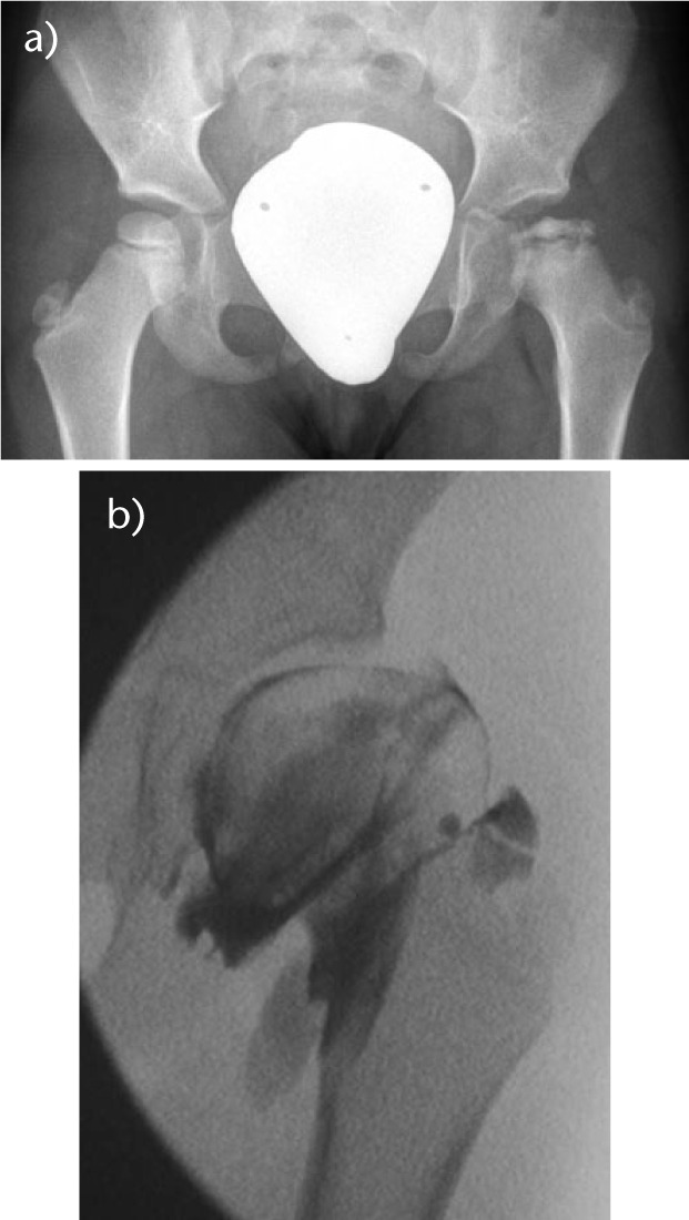 Fig. 2. 
          a) An anteroposterior (AP) radiograph of a five year old boy with left-sided Perthes disease with 'whole head' involvement. The epiphysis is sclerotic and beginning to fragment. b) An AP view of the same hip during an arthrogram which highlights that despite the bony deformity, the cartilaginous head is still spherical and matches the acetabulum (no dye pooling is seen). The dye outlines the labrum.
        