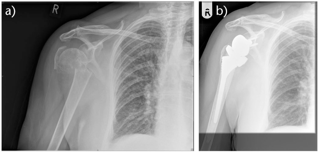 Fig. 6a and 6b 
          Reverse prosthesis for elderly osteoporotic proximal humeral fracture
        