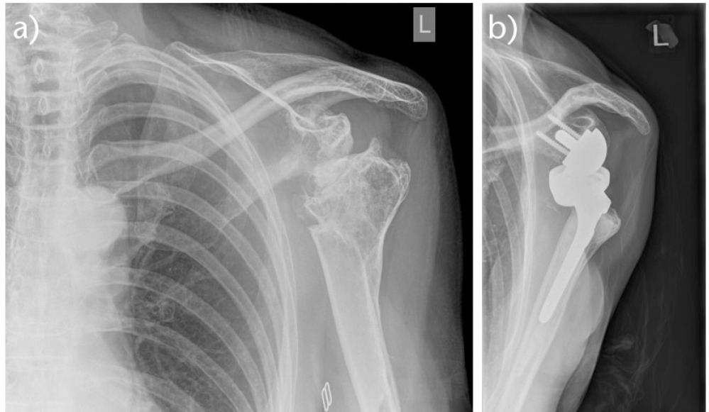 Fig. 7a and 7b 
          Reverse prosthesis for proximal humeral fracture malunion
        