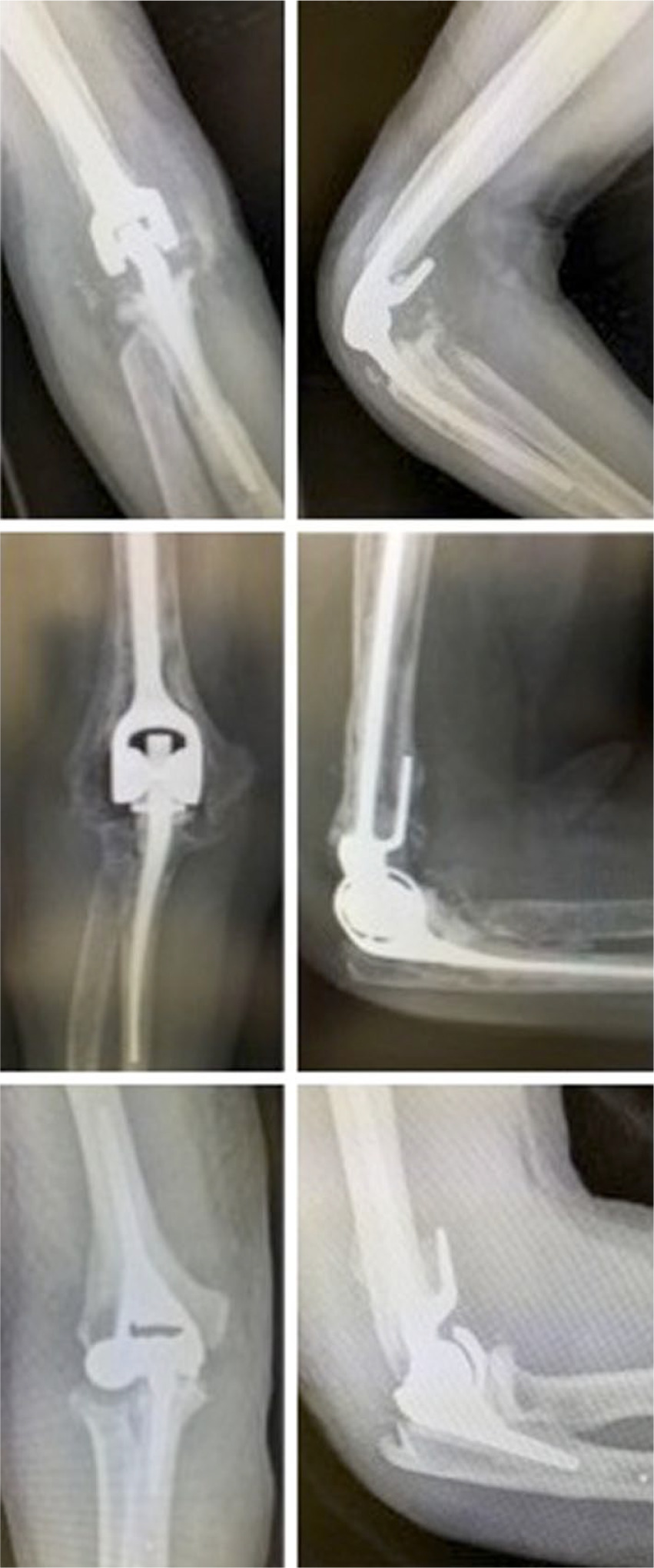 Fig. 3 
            Radiographs presenting commonly used linked prostheses. From top to bottom: Coonrad-Morrey; Discovery; and Latitude.
          