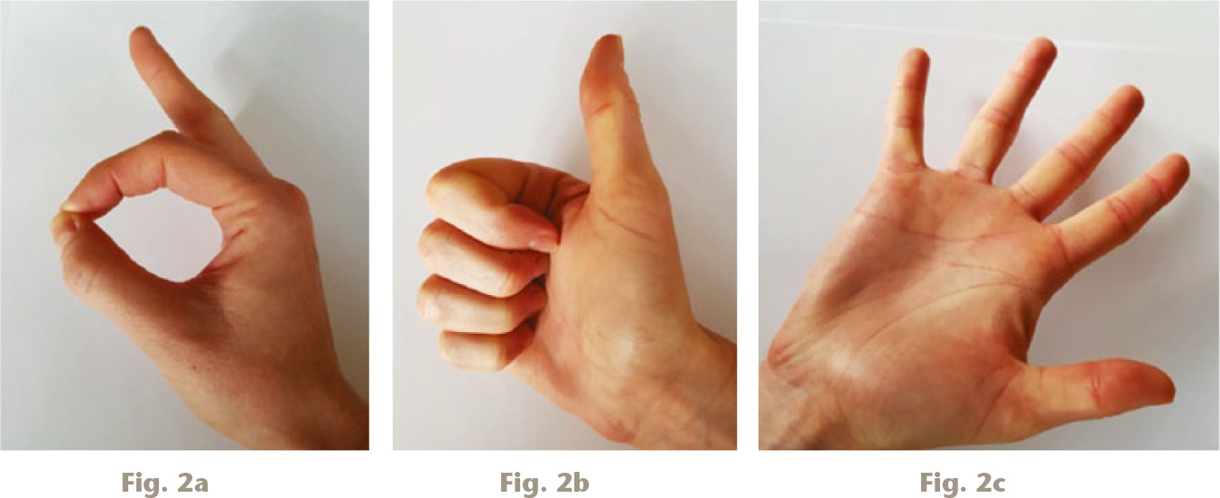  
            Assessing hand neurological supply in children. a) Testing the anterior interosseous nerve (AIN): ask the child to make an ‘OK’ sign, which indicates integrity of the index finger flexor digitorum profundus (FDP) and the flexor pollicis longus (FPL). This requires the child to flex his or her interphalangeal joints (IPJs). b) Testing radial motor function: ask the child to give a ‘thumbs up’ sign, which tests the extensor pollicis longus. c) Testing ulnar motor function: ask the child to make a starfish sign, which tests the finger abductors.
          