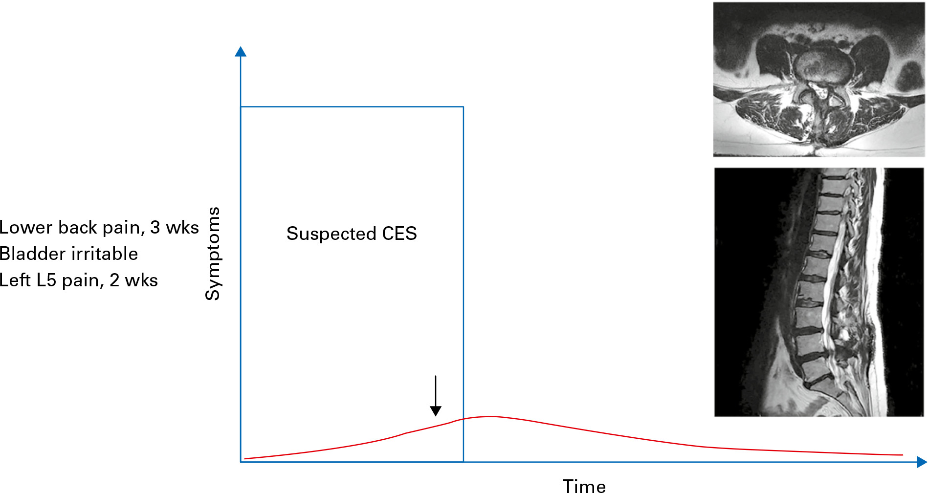 Fig. 2 
          Progression of cauda equina syndrome (CES) symptoms with time for a patient with suspected CES whose symptoms subsequently resolve.
        