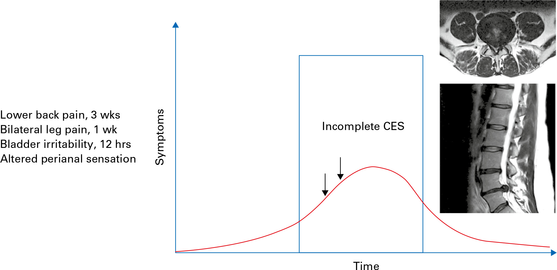 Fig. 3 
          Progression of cauda equina syndrome (CES) symptoms with time for a patient with incomplete CES whose symptoms recover postoperatively.
        