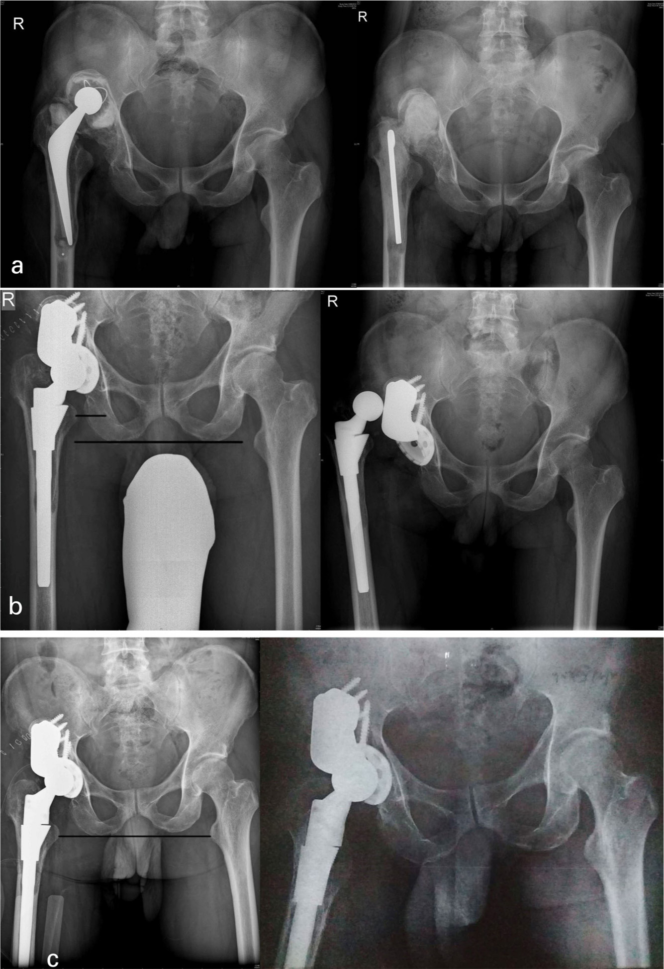 Fig. 2 
          (a) 41-year-old male with septic loosening , one year and four months postoperatively stage 1 revision THA with proximal migration and type 3a acetabular deficiency. (b) Postoperative acetabular reconstruction for type 3a defect with posterosuperior buttress augment and acetabulumcomponent with SROM femur, reduction stable at final reduction with extensive soft tissue release, dislocation three months postoperatively due to reduced offset causing impingement (c) Postoperative femoral shortening with femoral component changed to calcar replacement CR SROM (DePuy, USA) with restoration of offset (horizontal offset correction 10.5 mm to 32.7 mm (vertical offset 23.7 mm to 58.6 mm); four-year postoperatively showing componentnand augment well fixed with femoral component and osteotomy union.
        