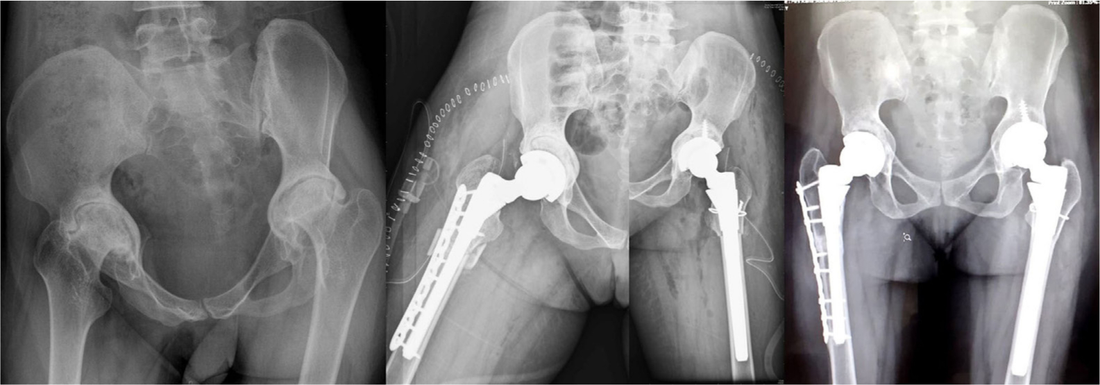 Fig. 3 
          21-year-old female with juvenile rheumatoid arthritis with bilateral type 3b acetabulum defect with 'for review only' protrusio, bilateral femoral shortening with plate for right femur for additional stability, and SS wiring for the proximal fragment for intraoperative split. Acetabulum impaction grafting with femoral head blocks, restored centre of rotation. 36-month follow-up with implant position well maintained and osteotomy site well united bilaterally. Acetabulum graft well incorporated. The combined offset measures 72.2 mm left and 72.8 mm right; the horizontal offset was 35.3 mm and 41.1 mm respectively without significant lateralization.
        