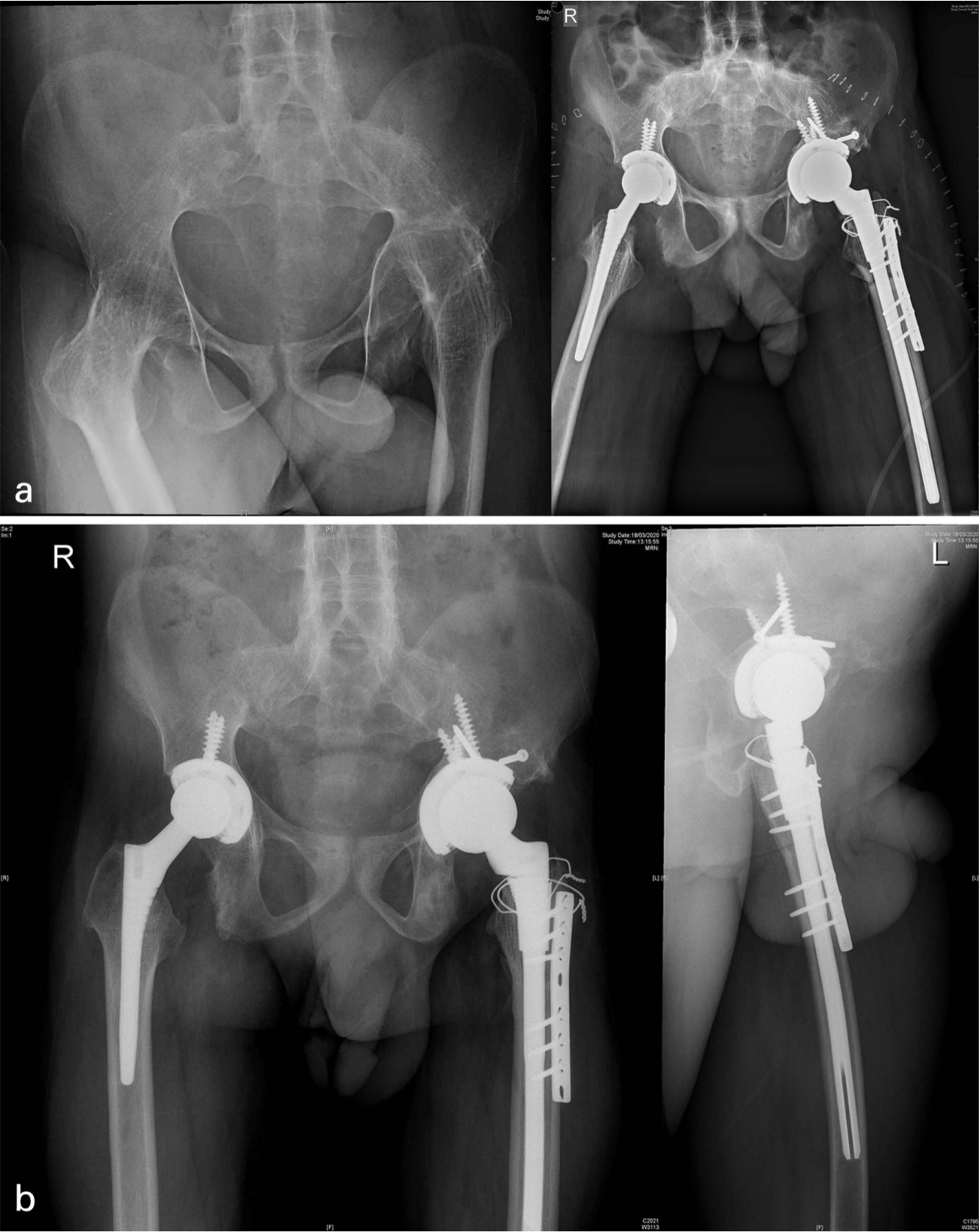 Fig. 4 
          (a) 31-year-old male with bilateral fused hips and ankylosing spondylitis. Proximal migration of the left hipwith femoral head and acetabular type 3b acetabular deficiency, bilateral THA with left hip femoral shortening. Acetabulum medial wall fracture, defect managed with bone graft and screws for superioraugmentation. SS wire for proximal femur incomplete split, femur plate for additional rotational stability. (b) 15-month follow-up with osteotomy site union, acetabulum graft well united. Lateral view confirming osteotomy site union and component femur position.
        