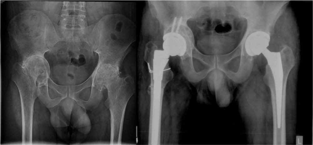 Fig. 5 
          36-year-old male with RA and Rt protrusio. Autografting acetabulum and component without significant lateralization and shortening with THA . Three months postoperative showing good union progress at osteotomy site.Right hip postop global offset 71 mm compared to 69.4 mm, horizontal offset 35.3 mm compared to 41.1 mm onthe contralateral side indicating hip not lateralized significantly. Pt is doing well at two years.
        