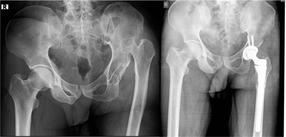 Fig. 6 
          49-year-old male with childhood arthritis sequelae with 5 cm shortening, eight months postoperative THA with extensive release, 42 mm acetabular component, femoral shortening signs of osteotomy site union.
        
