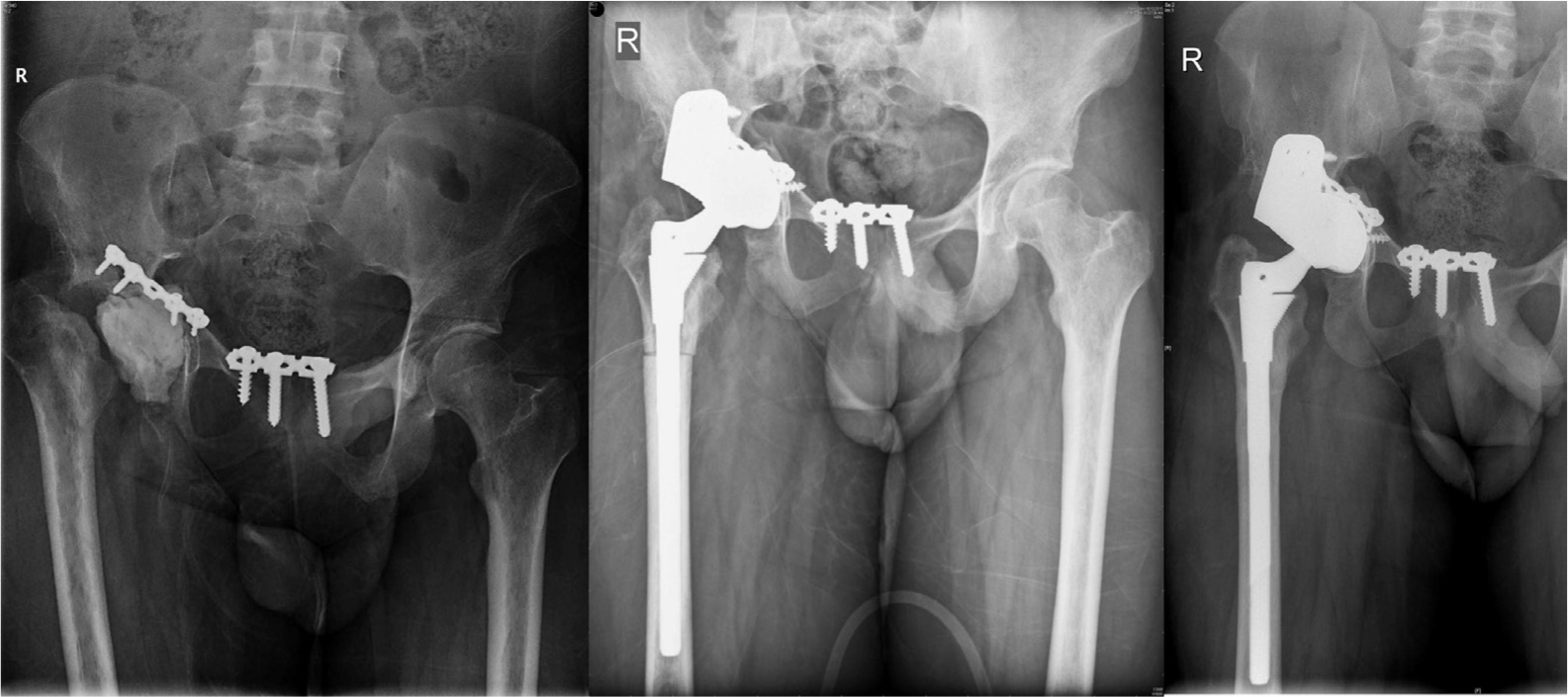 Fig. 7 
          19-year-old male with post-trauma surgery infection treated with spacer, augment for acetabular defect type 3 defect, femoral shortening with THA, two-year follow-up x-ray with osteotomy and acetabular fracture union, doing well at four years four months.
        