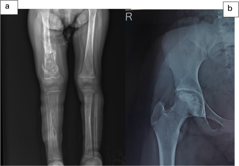 Fig. 1 
            Chronic osteomyelitis of right femur and bilateral tibia (a) and AVN of the right femoral head (b).
          