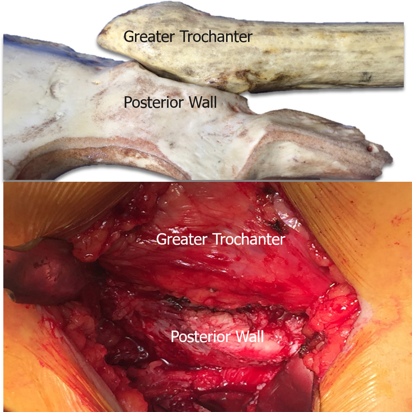 Fig. 2 
            Posterior wall exposed during arthroplasty and femoral neck completely covered by the posterior wall.
          