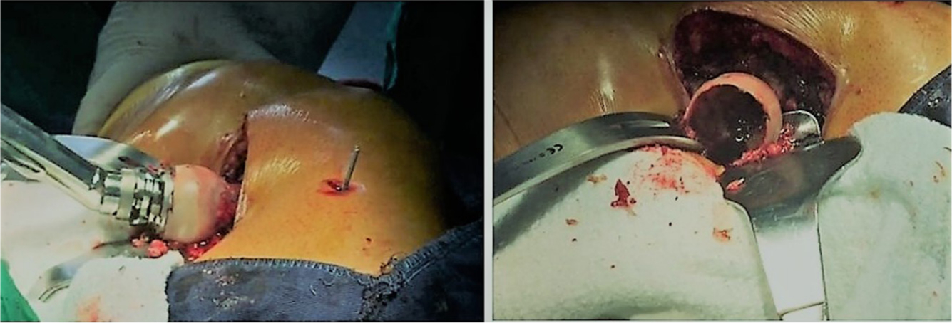 Fig. 4 
            Autograft intake directly reaming from the femoral head after dislocation and before making the femoral osteotomy.
          