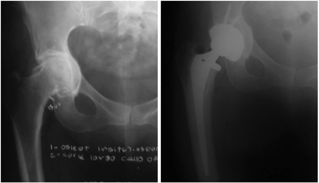 Fig. 5 
            Preoperative and postoperative x-rays.
          