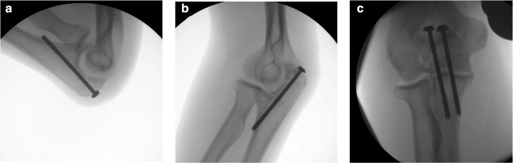 Fig. 2 
            Intra-operative assessment of fracture bicortical screw fixation stability with image intensifier: a) flexion; b) extension; c) anteroposterior.
          