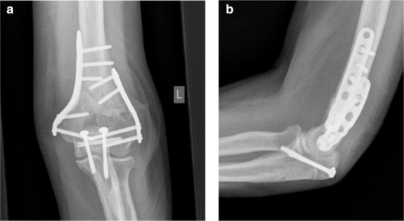 Fig. 3 
          Radiographs of bicortical screw fixation of olecranon osteotomy: a) anteroposterior; b) lateral.
        