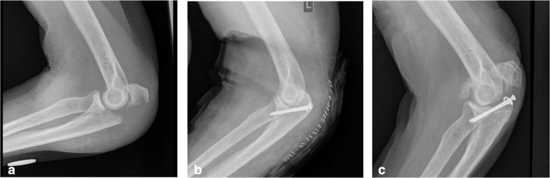 Fig. 4 
          Lateral radiographs of elbow: a) displaced olecranon fracture (Mayo IIA); b) postoperative fixation with two bicortical screws; c) loss of reduction.
        