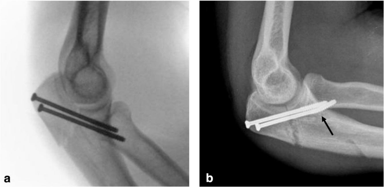 Fig. 5 
          a) image intensifier lateral of percutaneous olecranon fracture fixation with bicortical screws; b) lateral radiograph of elbow showing fracture of inferior screw indicated by arrow.
        