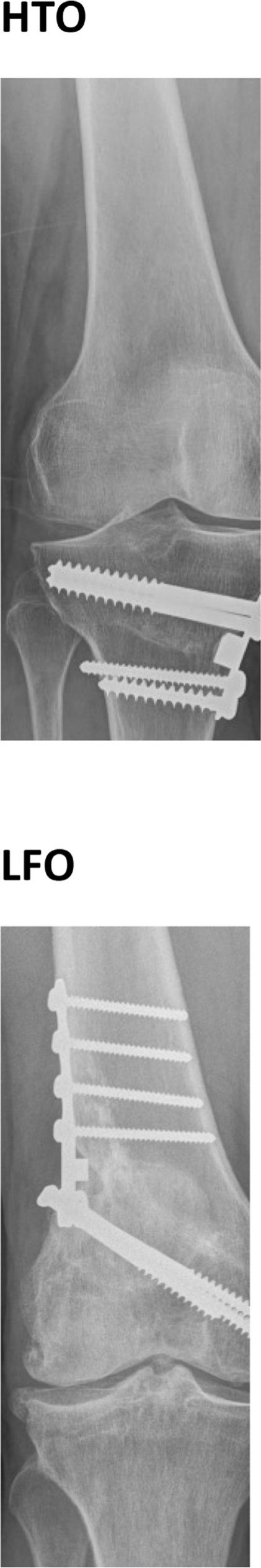 Fig. 1 
          High tibial osteotomy (HTO) ten years after an angular correction of 8° and low femoral osteotomy (LFO) ten years after an angular correction of 6° (frontal views). Note the open medial, respectively lateral joint spaces. Both patients had a good knee function.
        