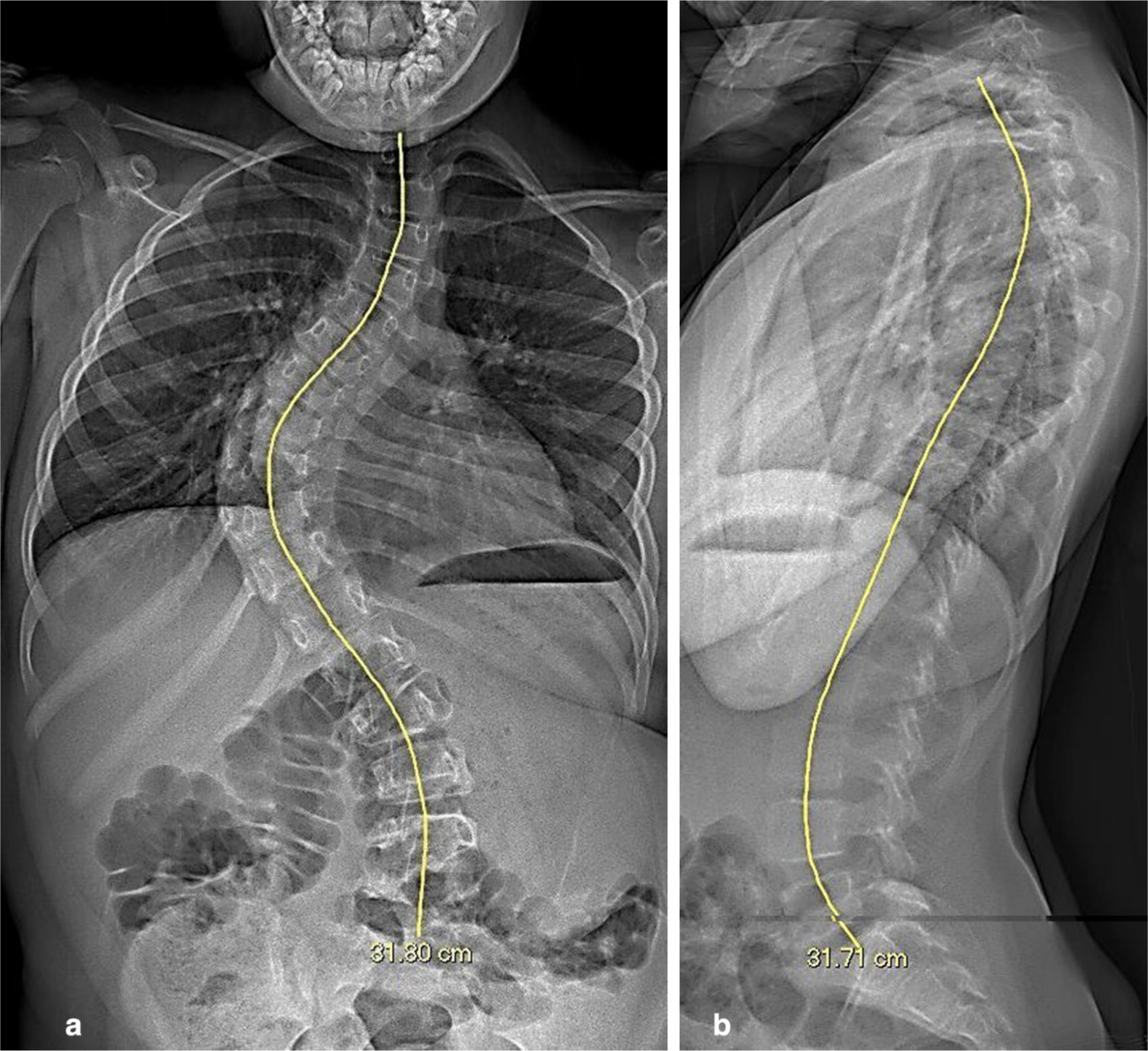 Fig. 1 
            a) Pre-operative coronal view radiograph with T1-S1 measurement. b) Pre-operative sagittal view radiograph with T1-S1 measurement.
          
