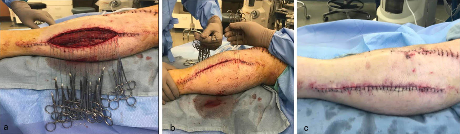 Fig. 2 
          Clinical photograph of a tension free fasciotomy using the described suture technique: (a) Each suture is thrown and snapped; (b) Even tension is then pulled across each suture to approximate the skin edges prior to tying resulting in (c) a well approximated, tension-free closure.
        