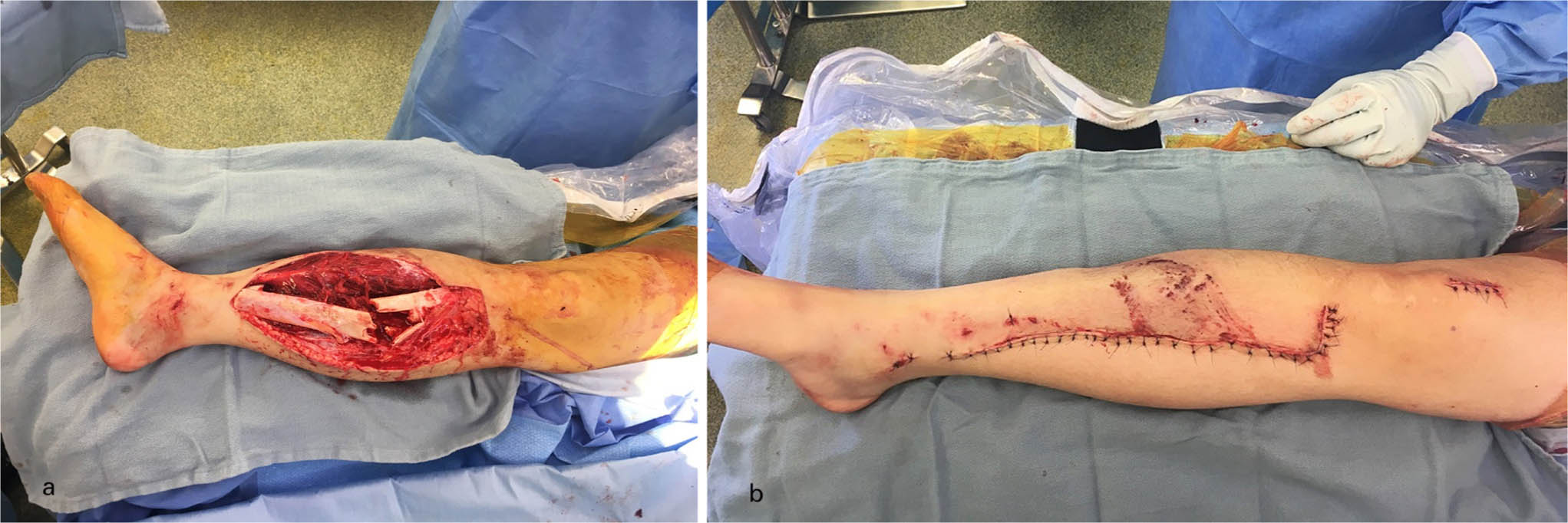 Fig. 3 
          Clinical photograph of a severe open tibia fracture before (a) and after (b) acute closure.
        