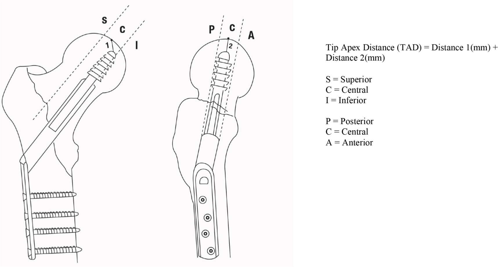 Fig. 2 
            Schematic diagram of dynamic hip screw measurements, anteroposterior and lateral views.
          