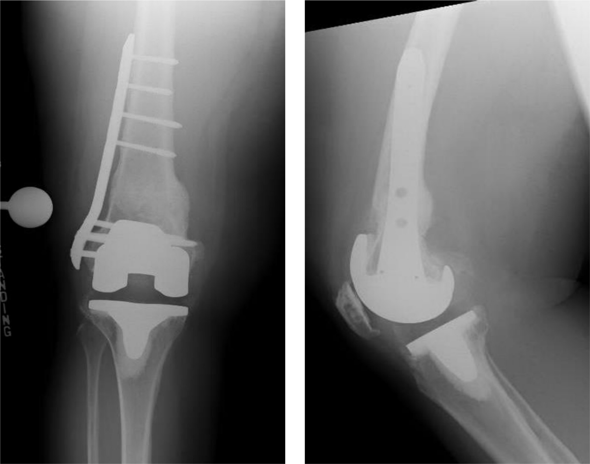 Fig. 1 
            Radiographs illustrating a modified Radiological Union Scale for Tibia fractures (mRUST) score of 15 at final follow-up. Cortical score: lateral = 4, medial = 4, anterior = 3, and posterior = 4.
          