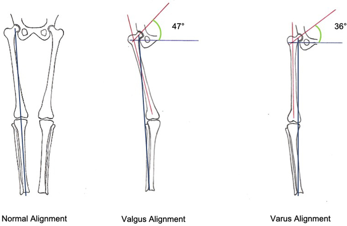 Fig. 1 
            An illustration demonstrating the concept of the influence of frontal knee alignment on the vertical orientation of the femoral neck. The valgus knee demonstrates a more vertical orientation of the femoral neck (middle), while a varus knee demonstrates a more horizontal orientation (right image).
          