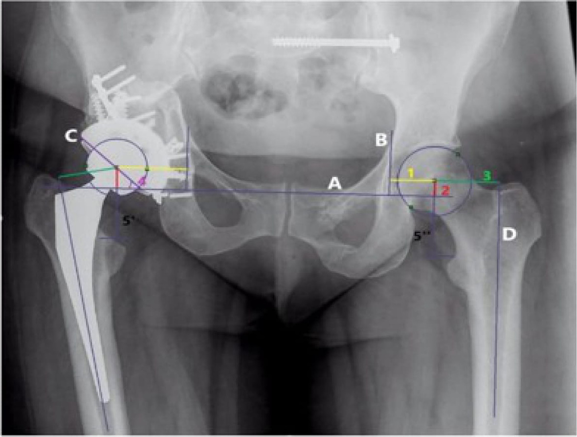 Fig. 1 
            Analysis of postoperative radiograph after uncemented total hip arthroplasty. A, horizontal teardrop line. B, vertical teardrop line. C, line along the lateral surface of the acetabular component. D, femoral shaft line. 1, horizontal hip centre of rotation (COR). 2, vertical hip COR. 3, Horizontal femoral offset. 4, the abduction angle. 5, limb length discrepancy: difference between 5’ (vertical distance from the tear-drop line to lesser trochanter in the operated side) and 5’’ (vertical distance from the tear-drop line to lesser trochanter in the nonoperated side).
          