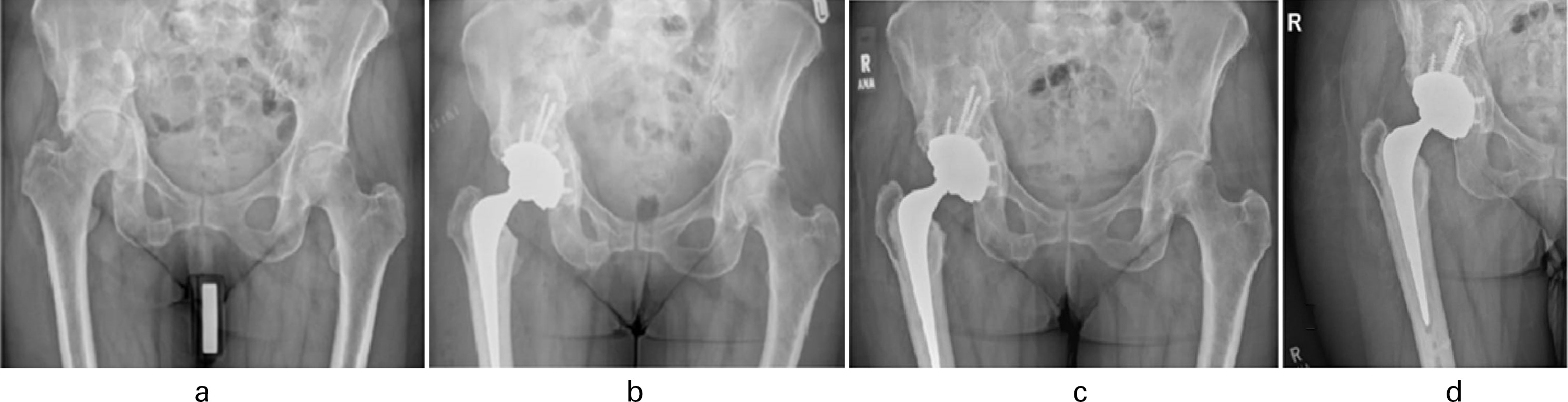 Fig. 3 
            73-year-old female patient who had a delayed right-sided uncemented total hip arthroplasty (THA). a) Preoperative anteroposterior (AP) radiograph showing osteoarthritis of right hip. b) Immediate postoperative AP radiograph view with right THA. c) and d) AP radiograph view after one-year follow-up following right THA.
          
