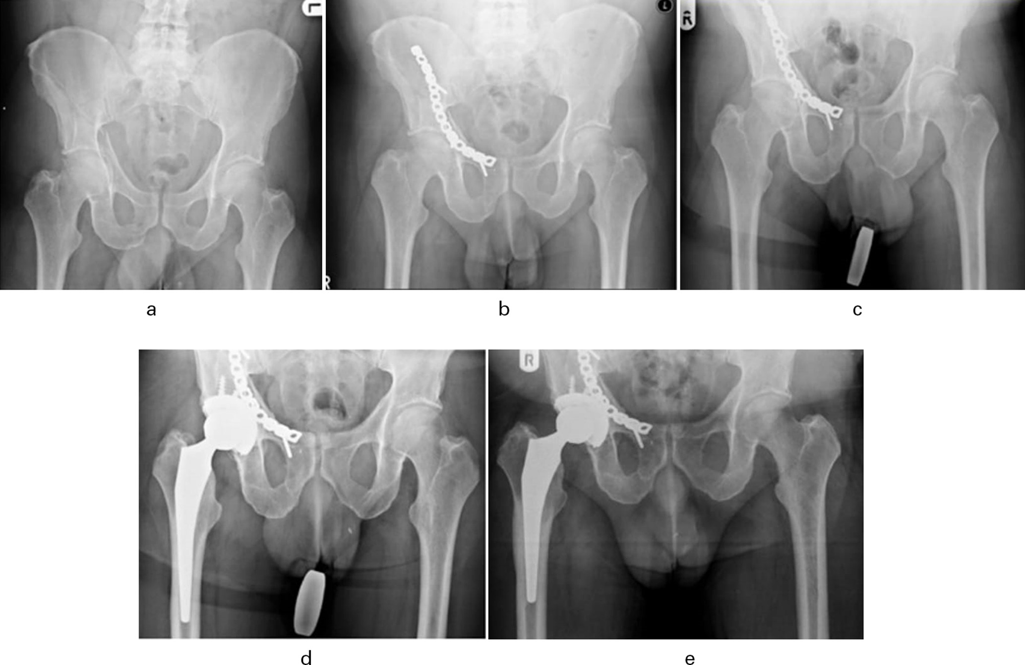 Fig. 4 
            58-year-old male patient who had a delayed right-sided uncemented total hip arthroplasty (THA). a) Initial injury anteroposterior (AP) radiograph showing right acetabular fracture. b) Initial AP radiograph post-open reduction and internal fixation of the right acetabular fracture. c) Preoperative AP radiograph showing osteoarthritis of the right hip. d) Immediate AP radiograph post-THA. e) A seven-year follow-up AP radiograph showed no loosening or osteolysis around the acetabular or femoral component.
          