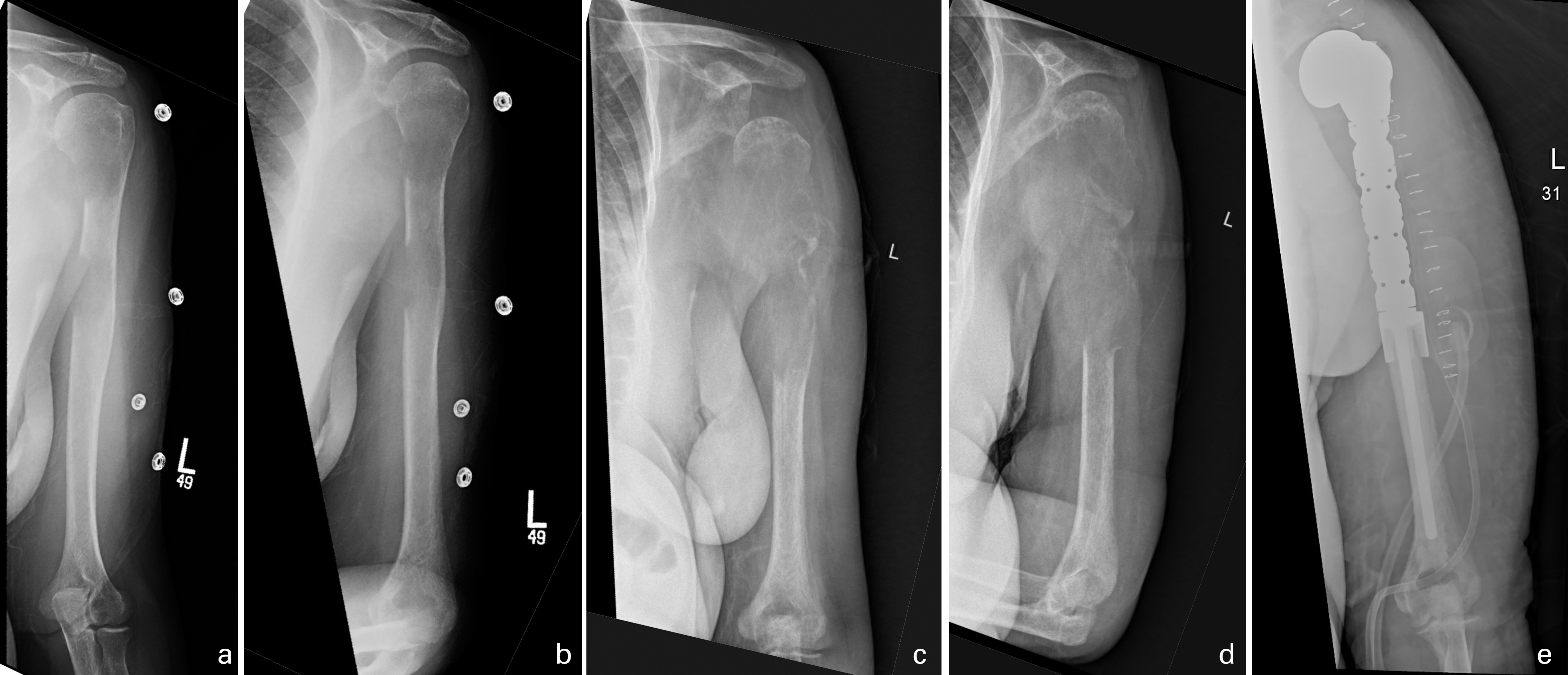 Fig. 2 
          76-year-old female with poorly differentiated metastatic lung carcinoma to bone, prioritized as level III. Anteroposterior (AP), external rotation, and internal rotation radiographs of the left humerus, a) and b) 11 February 2020 and c) and d) 24 April 2020. e) Postoperative AP view, 2 May 2020. Extensive progressive interval osseous destruction with extraosseous soft tissue mass involving the left proximal humerus to mid-shaft diaphysis with associated pathological fracture. Due to COVID-19 related delays, this patient experienced prolonged pain and disability, unplanned radiation, and local tumour progression resulting in markedly increased surgical complexity.
        