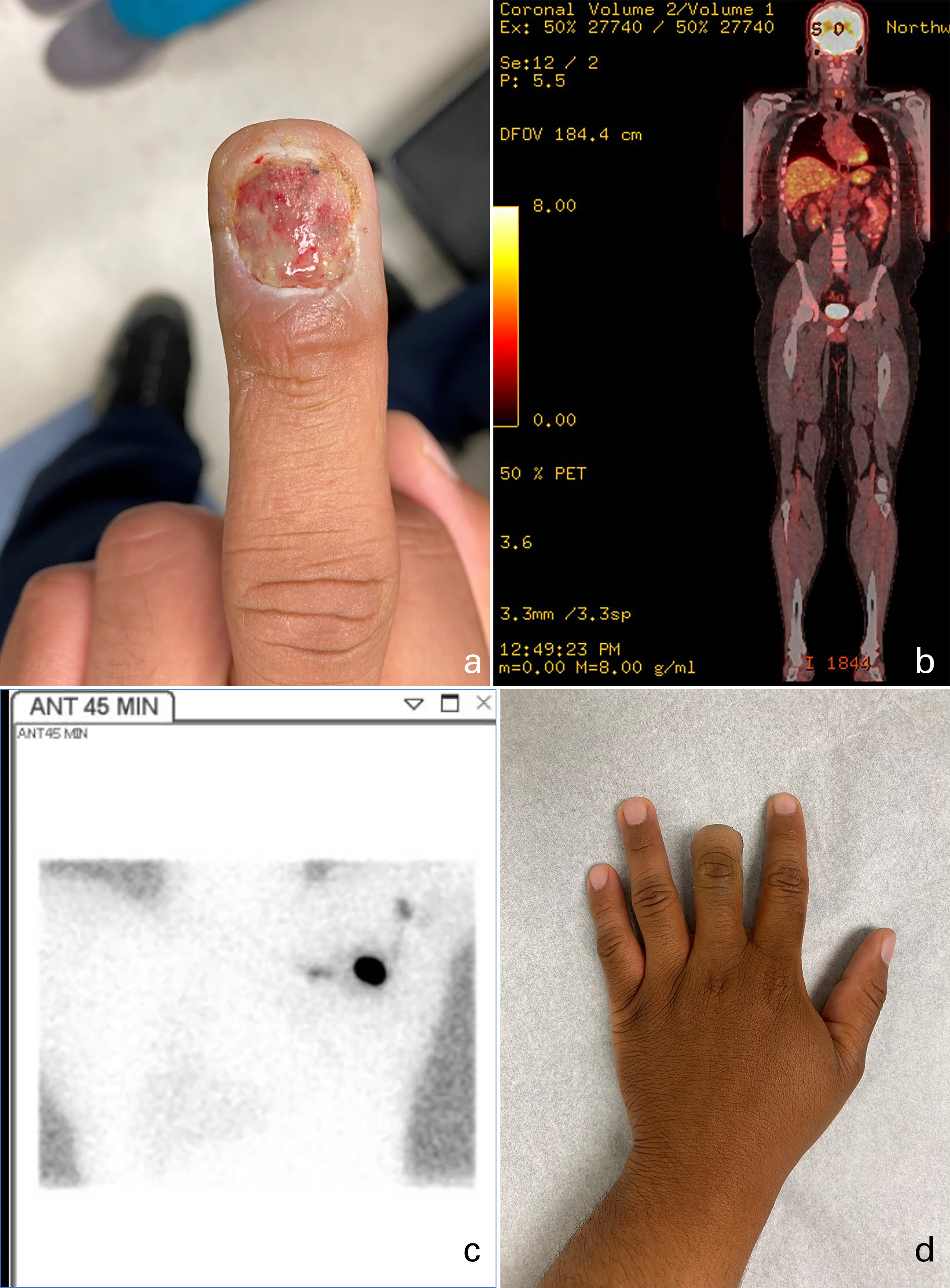 Fig. 4 
          31-year-old male with high-grade malignant melanoma of the left long finger, prioritized as level III. a) Gross image, 16 March 2020. b) Preoperative coronal positron emission tomography scan, negative for systemic pathological fluorodeoxyglucose uptake, 25 March 2020. c) Lymphoscintigraphy on the day of surgery (20 May 2020), demonstrating left axillary and pectoral nodal accumulation of radiopharmaceutical material. d) Postoperative gross image. Final pathology of the axillary lymph node was positive for malignant melanoma. Due to COVID-19 related delays, this patient may have experienced increased systemic tumour progression.
        