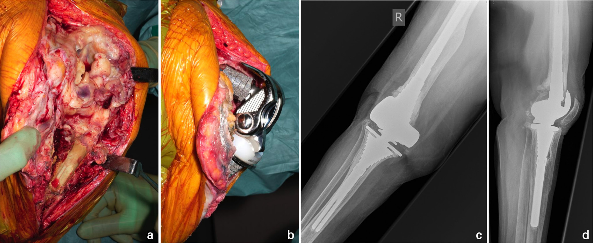 Fig. 1 
            a) Intraoperative clinical photographs demonstrate an extensile approach—incorporating a tibial crest osteotomy (TCO)—to explant an infected complex primary total knee arthroplasty in a 76-year-old female, revealing extensive biofilm. b) Following debridement, cementless reimplantation was undertaken with a hinged prosthesis, as the collateral ligaments were unsalvageable. c) Anteroposterior and d) lateral right knee radiographs at four years postoperatively show the TCO has healed and the components appear well-fixed.
          