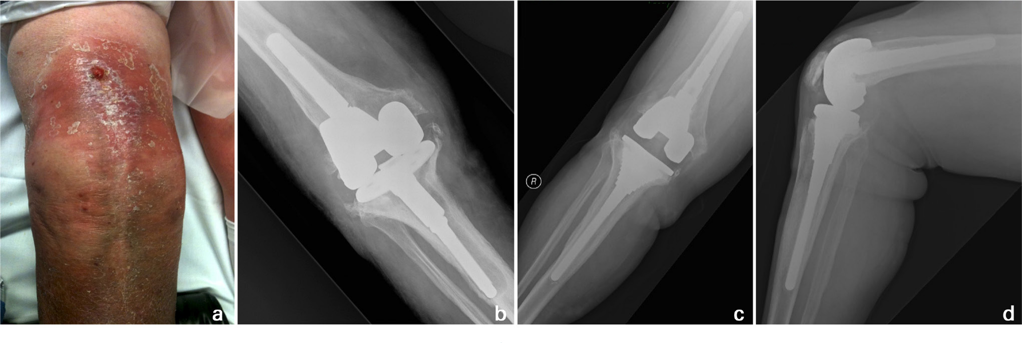 Fig. 2 
            a) Preoperative clinical photograph demonstrates a sinus in the line of a previous scar with surrounding erythema. b) The corresponding anteroposterior right knee radiograph shows extensive osteolysis around the underlying revision total knee arthroplasty prosthesis. This 78-year-old female underwent single-stage re-revision. Excision of the collateral ligaments was not required during the debridement in this particular case, and increased constraint was accordingly unnecessary. Stable zonal fixation with cementless components was achieved, as shown on c) anteroposterior and d) lateral right knee radiographs at three years postoperatively.
          