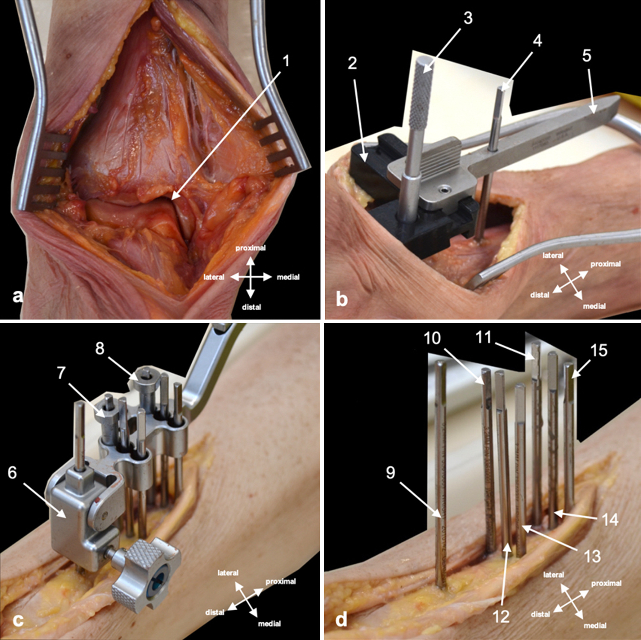 Fig. 1 
          This figure demonstrates exposing the anterior ankle joint; a) and installing all relevant transcortical pins (b to d). 1) Ankle joint; 2) rotation guide slide; 3) medial gutter fork; 4) distal most pin; 5) rotation guide pointer; 6) alignment frame; 7) distal pin sleeve; 8) proximal pin sleeve; 9) distal most pin; 10) lateral-distal pin; 11) lateral-proximal pin; 12) central-distal pin; 13) medial-distal pin; 14) central-proximal pin; and 15) medial-proximal pin. These images were acquired with appropriate consent in accordance with the Human Tissue Act 2006.
        