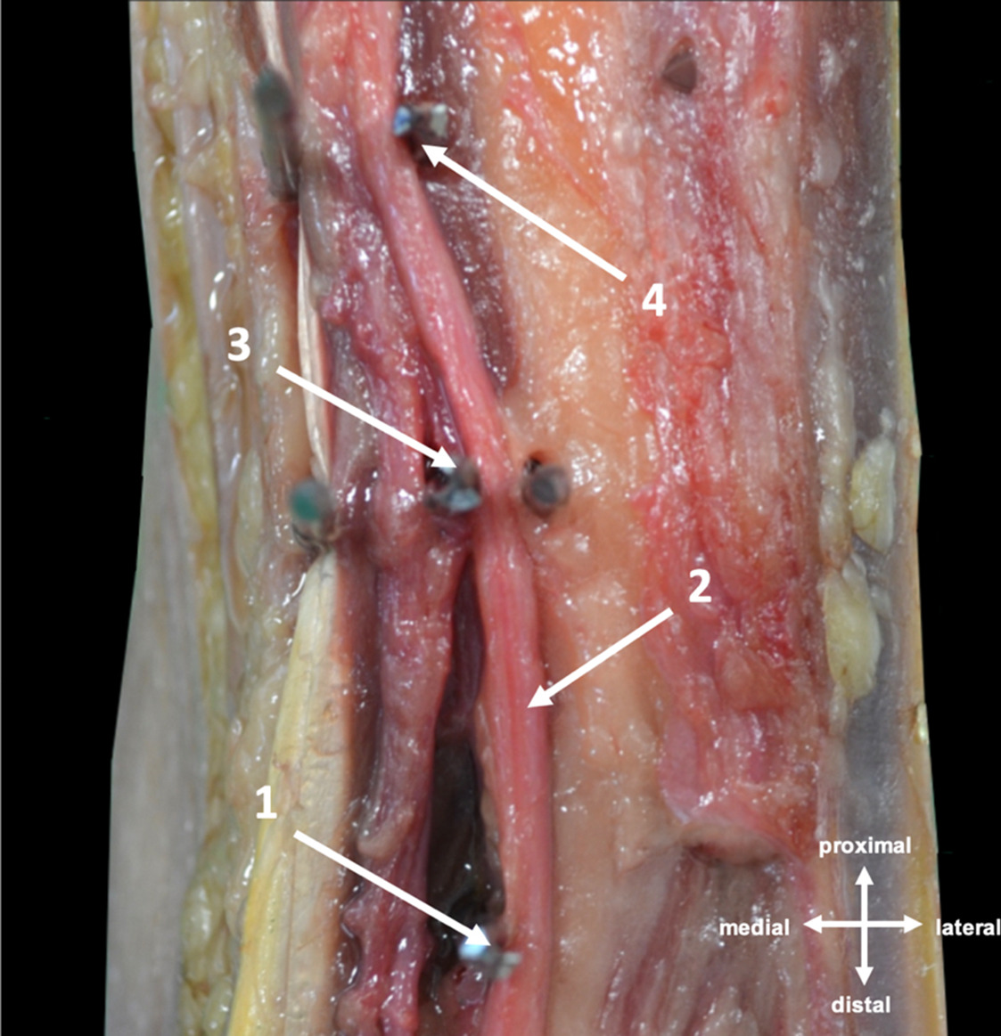 Fig. 2 
          Distal-most, central-proximal, and central-distal tibial pins making direct contact with the tibial nerve. This image was taken from the posterior aspect of a right-sided cadaveric ankle. 1) Distal-most pin; 2) tibial nerve; 3) central-distal pin; and 4) central-proximal pin. These images were acquired with appropriate consent in accordance with the Human Tissue Act 2006.
        