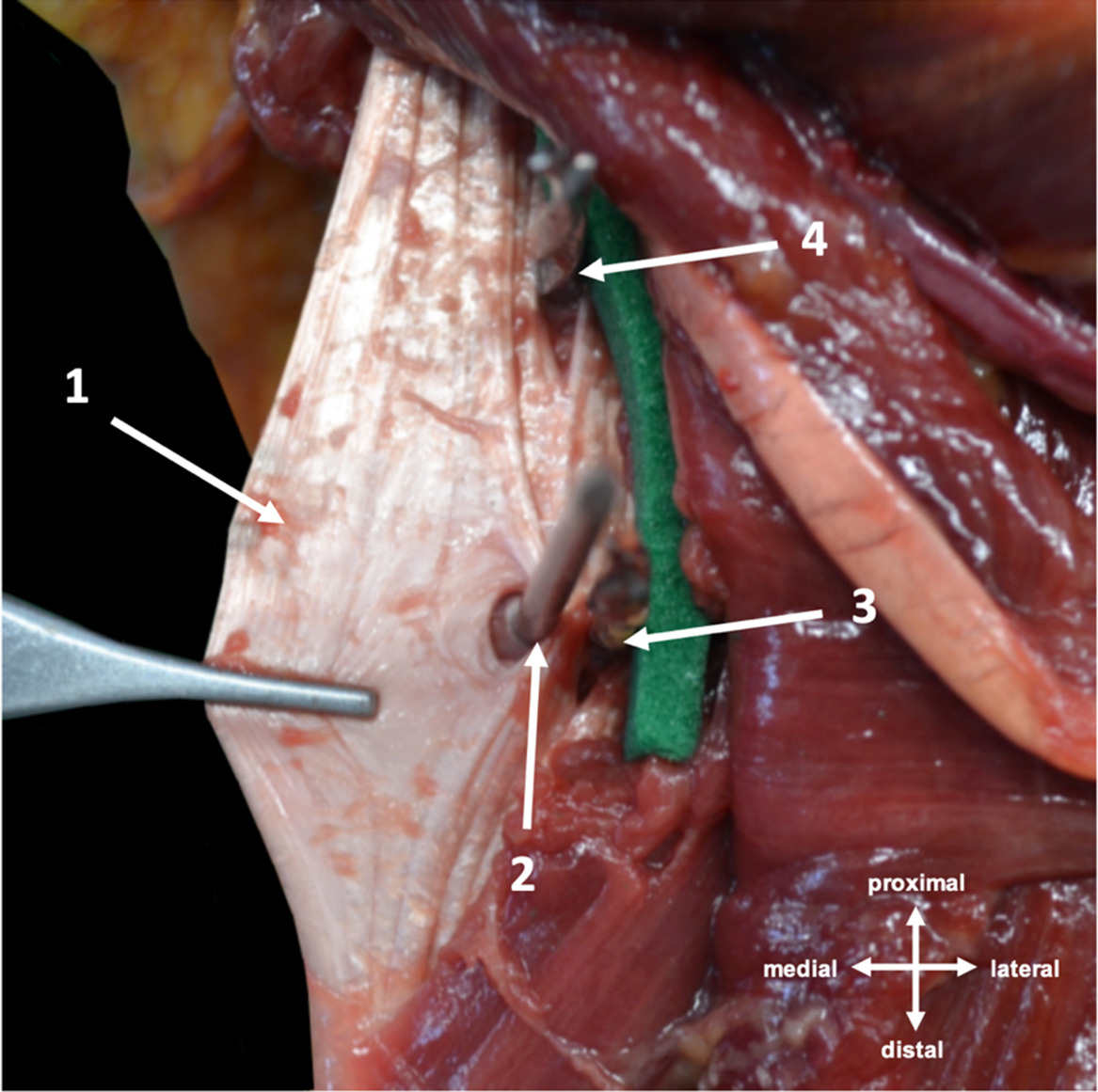 Fig. 5 
          Medial-distal, central-proximal, and central-distal pins causing gross structural damage to the tibialis posterior tendon. This image was taken from the posterior aspect of a right-sided cadaveric ankle. 1) tibialis posterior tendon; 2) medial-distal pin; 3) central-distal pin; and 4) central-proximal pin. These images were acquired with appropriate consent in accordance with the Human Tissue Act 2006.
        